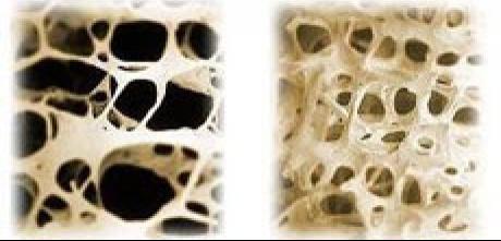 osteoporoza