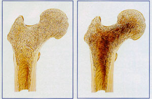osteoporoza